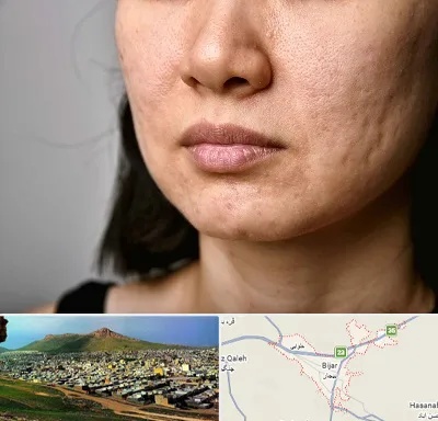 سابسیژن جای جوش در بیجار