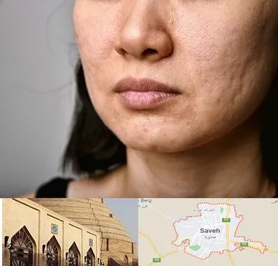 سابسیژن جای جوش در ساوه