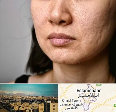 سابسیژن جای جوش در اسلامشهر