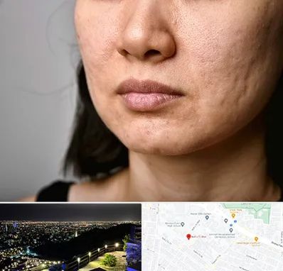 سابسیژن جای جوش در هفت تیر مشهد 