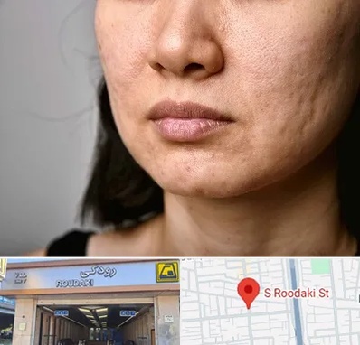 سابسیژن جای جوش در رودکی