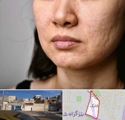 سابسیژن جای جوش در اتابک