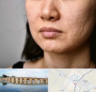 سابسیژن جای جوش در فلاورجان