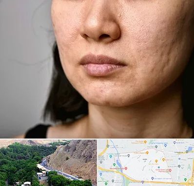 سابسیژن جای جوش در کن 