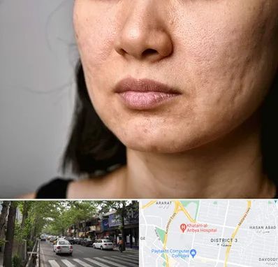 سابسیژن جای جوش در ظفر 