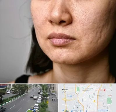 سابسیژن جای جوش در ستارخان 