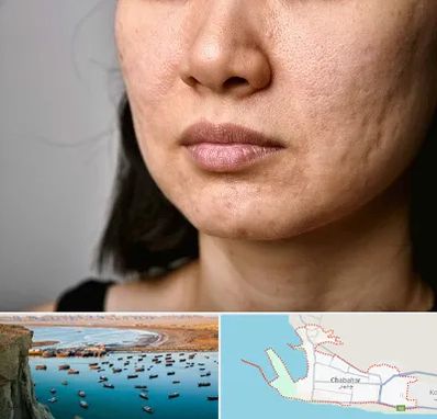 سابسیژن جای جوش در چابهار