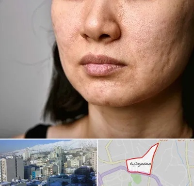 سابسیژن جای جوش در محمودیه