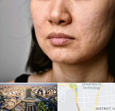 سابسیژن جای جوش در استاد معین 