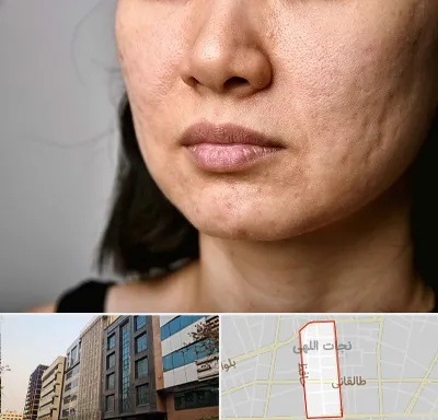 سابسیژن جای جوش در نجات اللهی