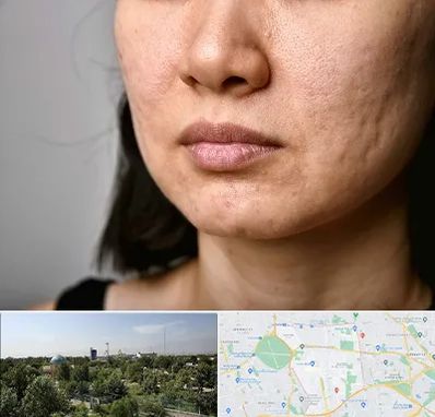 سابسیژن جای جوش در منطقه 16 تهران 