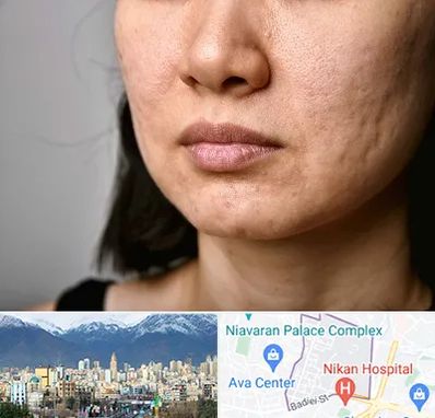 سابسیژن جای جوش در آجودانیه 