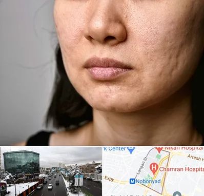 سابسیژن جای جوش در اقدسیه 