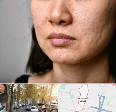 سابسیژن جای جوش در کاشانک