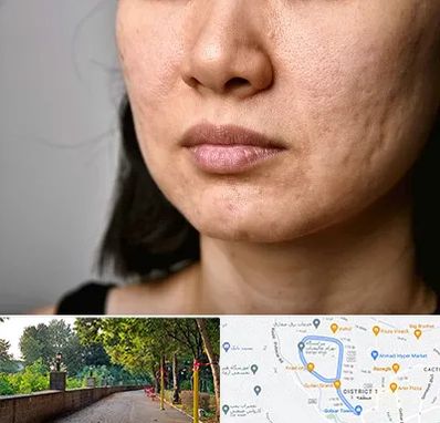 سابسیژن جای جوش در بلوار گیلان رشت