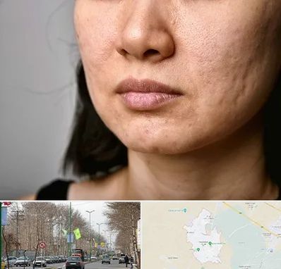 سابسیژن جای جوش در نظرآباد کرج 