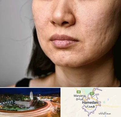 سابسیژن جای جوش در همدان