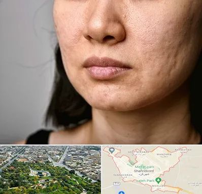 سابسیژن جای جوش در شهرکرد