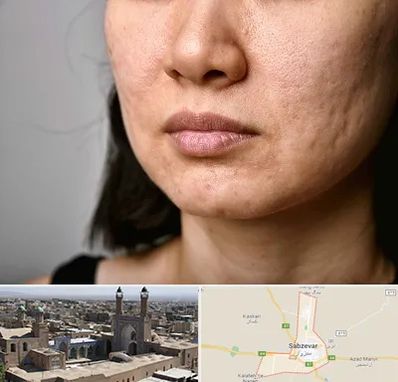 سابسیژن جای جوش در سبزوار