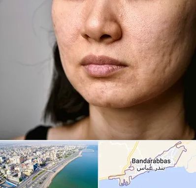 سابسیژن جای جوش در بندرعباس