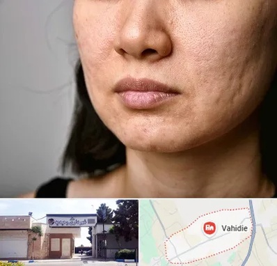 سابسیژن جای جوش در وحیدیه شهریار