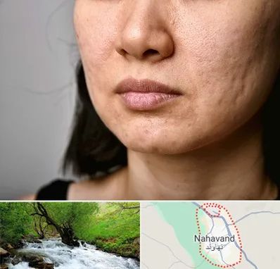سابسیژن جای جوش در نهاوند