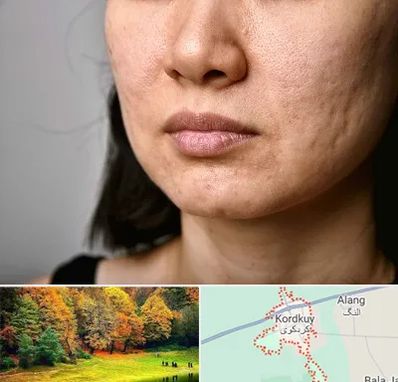سابسیژن جای جوش در کردکوی