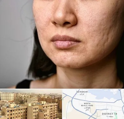 سابسیژن جای جوش در جنوب غرب تهران