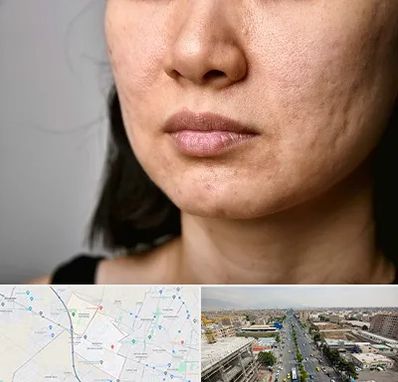 سابسیژن جای جوش در حصارک کرج