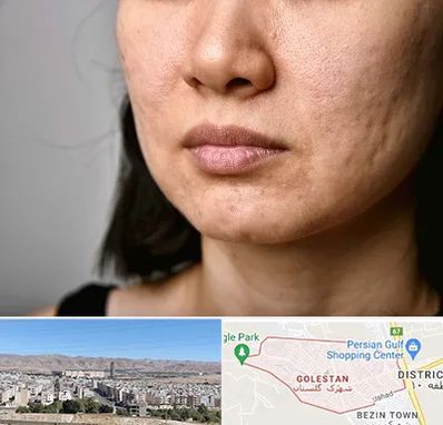 سابسیژن جای جوش در شهرک گلستان شیراز