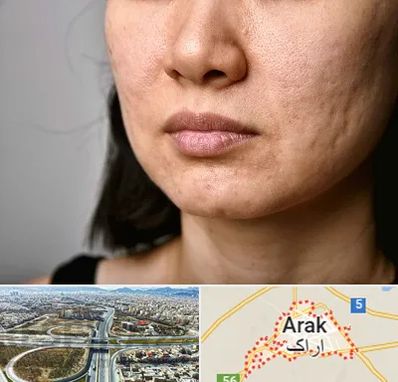 سابسیژن جای جوش در اراک