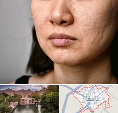 سابسیژن جای جوش در دامغان