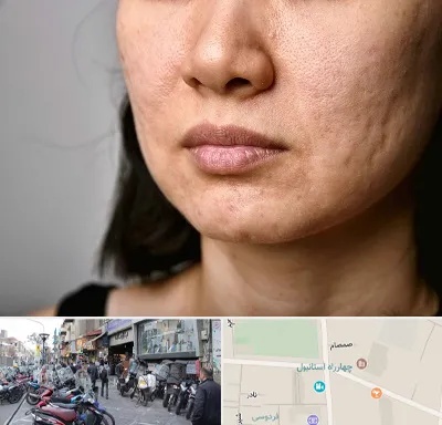 سابسیژن جای جوش در چهارراه استانبول