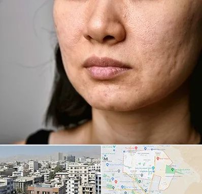 سابسیژن جای جوش در منطقه 14 تهران 