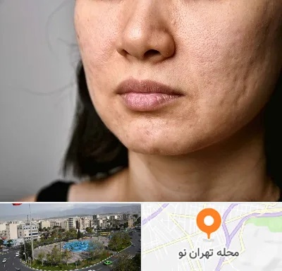 سابسیژن جای جوش در تهران نو