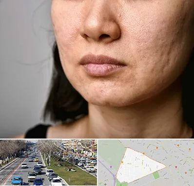 سابسیژن جای جوش در احمدآباد مشهد 