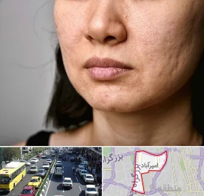 سابسیژن جای جوش در امیرآباد