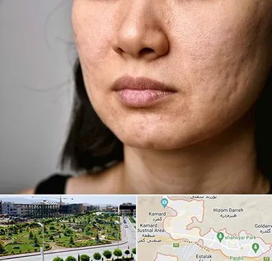 سابسیژن جای جوش در پردیس