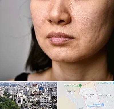 سابسیژن جای جوش در ولنجک 