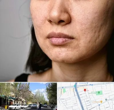 سابسیژن جای جوش در کوی فیروز تبریز