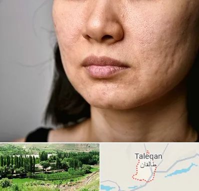 سابسیژن جای جوش در طالقان