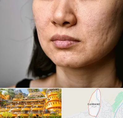 سابسیژن جای جوش در دربند