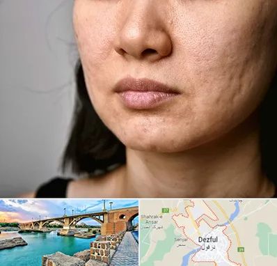 سابسیژن جای جوش در دزفول