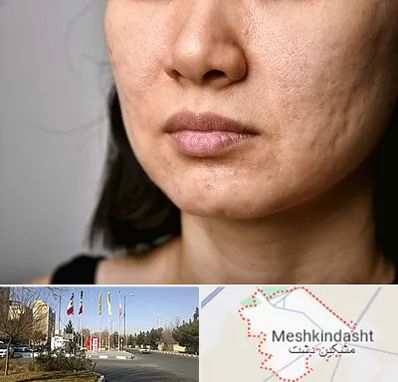 سابسیژن جای جوش در مشکین دشت