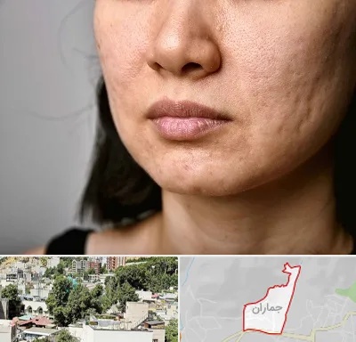 سابسیژن جای جوش در جماران