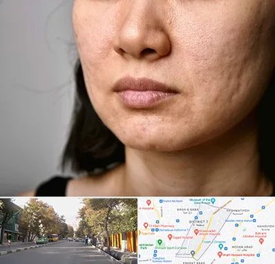 سابسیژن جای جوش در شریعتی 