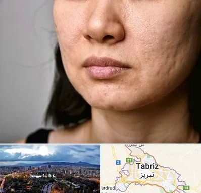 سابسیژن جای جوش در تبریز