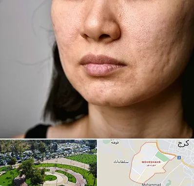 سابسیژن جای جوش در مهرشهر کرج 