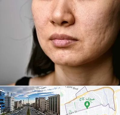 سابسیژن جای جوش در سعادت آباد 