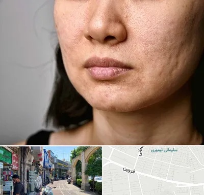 سابسیژن جای جوش در خیابان قزوین